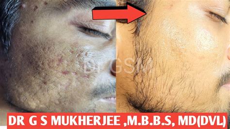 Microneedling Rf Mnrf Treatment For Acne Scars Mnrf Skin Treatment