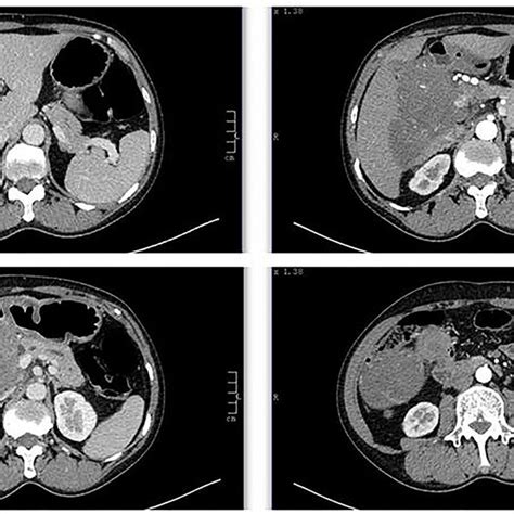 Computed Tomography Ct Scan Showed A Retroperitoneal Soft Tissue Download Scientific Diagram