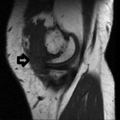 Pdf Synovial Hemangioma In The Knee Mri Findings