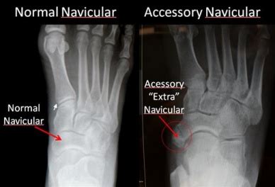 Accessory Navicular Bone - Physiopedia