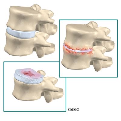 Lumbar Degenerative Disc Disease | eOrthopod.com