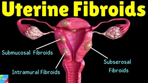 Uterine Fibroids Types Symptoms Causes Diagnosis Treatment And