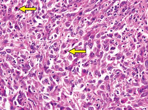 Imaging Of Histiocytosis In The Era Of Genomic Medicine Radiographics