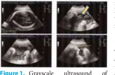 Figure 1 From Single Umbilical Artery SUA Prenatal Sonography