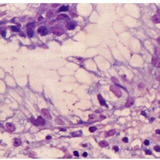 The foveolar epithelium shows hyperplasia. Marked infiltration of ...