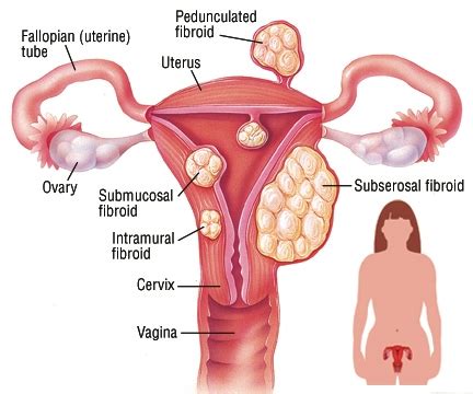 Uterine Fibroids Symptoms, Diagnosis, Treatment - Advanced GYN Clinic