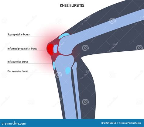 Bursitis Inflammation Concept Cartoon Vector Cartoondealer