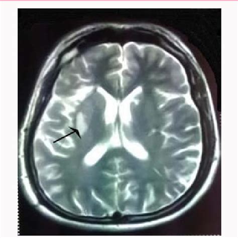 MRI brain: Image of acute infarcts in right basal ganglia and corona ...