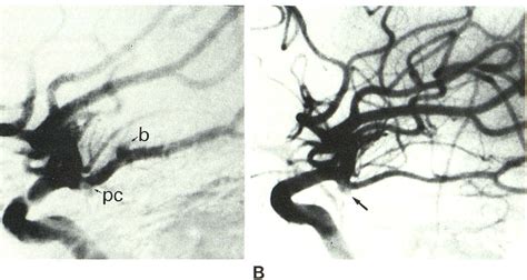 Figure I From Development Of Aneurysm From Infundibulum Of Posterior Communicating Artery With