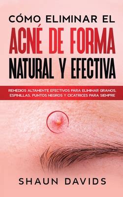 C Mo Eliminar El Acn De Forma Natural Y Efectiva Remedios Altamente