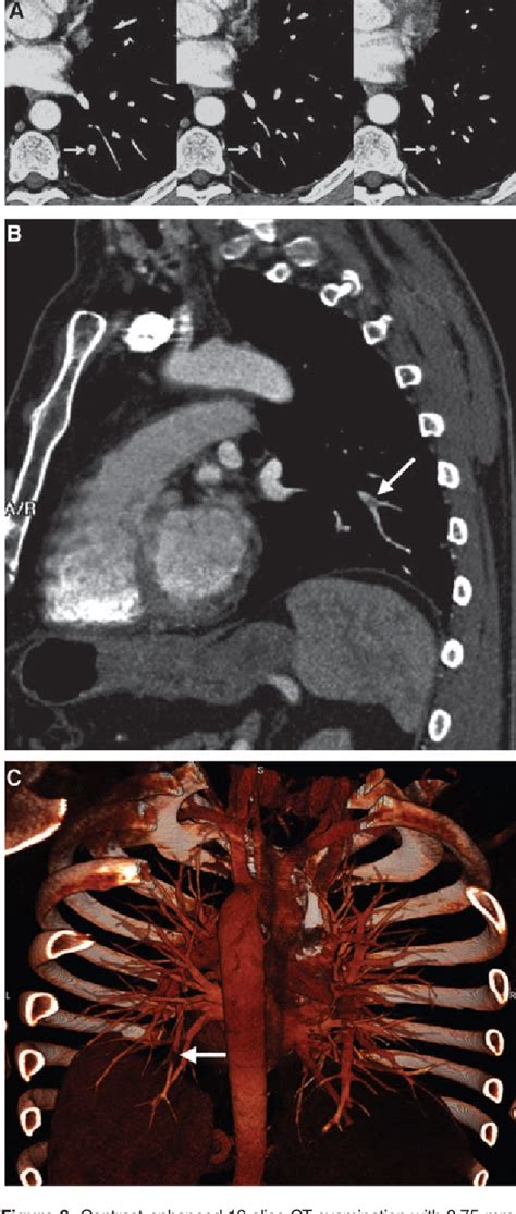 Figure 2 From Spiral Computed Tomography For Acute Pulmonary Embolism