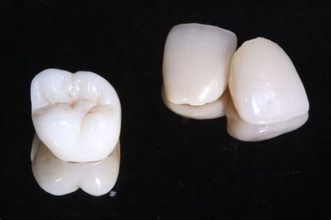 IPS E Max Porcelain Crown And Veneers Olivadds Dental