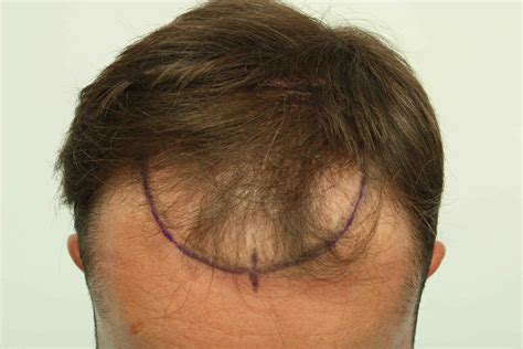 Post Op Recovery Photographs 2 Weeks After Fue Hair Transplant Procedure