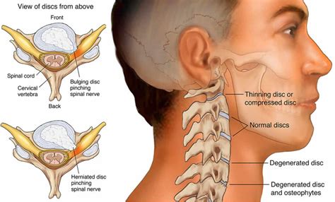 Cervical Radiculopathy Motus Physical Therapy