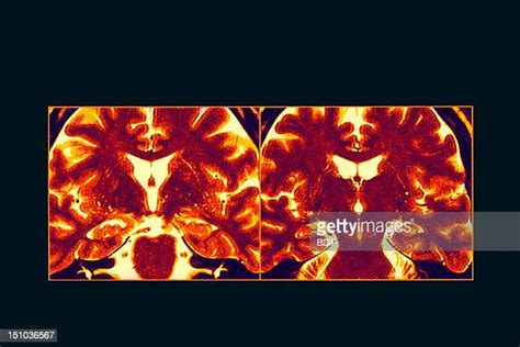 Hippocampus Brain Scan Photos And Premium High Res Pictures Getty Images