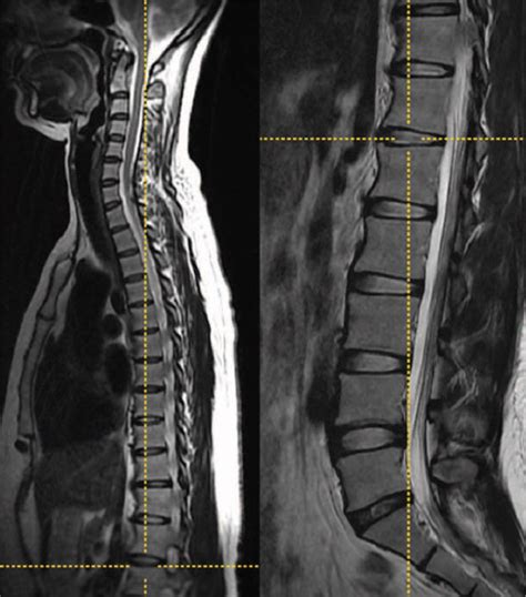 A Review Of Symptomatic Lumbosacral Transitional Vertebrae Bertolotti