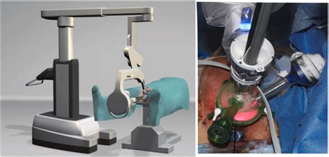 The Evolution Of Single Port Robot Assisted Transperineal Radical