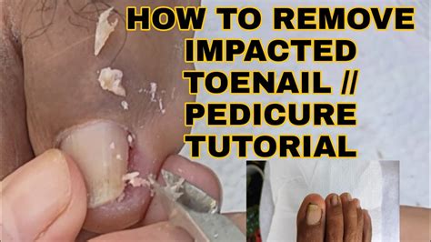 How To Remove Ingrown Toenail And Impacted Toenail Relief And Prevention Pedicure Tutorials