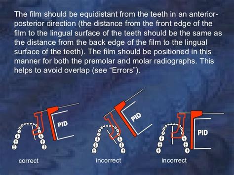 radiology-bitewing-technique