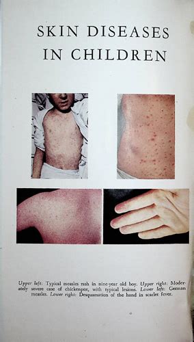 Skin Diseases In Children