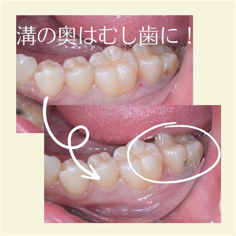 当院でのむし歯の診断について 和歌山県岩出市の歯科・歯医者