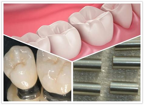 Nickel Chrome Damcast Alloy Dental Soft Alloy China Manufacturer