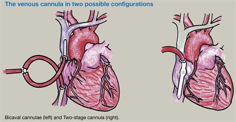 Cardiopulmonary Bypass Anaesthesia And Intensive Care Medicine