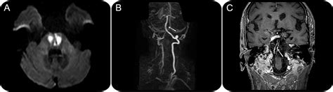 Neurosyphilis Mri