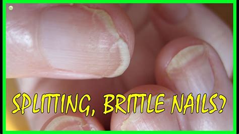 This Is Why Your Nails Keep Splitting Brittle Nails Causes Best