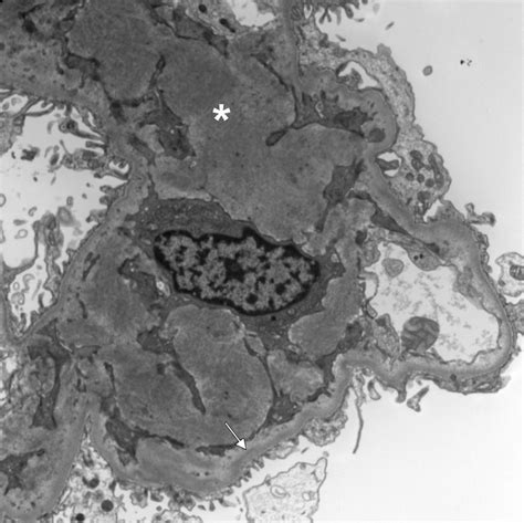 AJKD Atlas Of Renal Pathology Light And Heavy Chain Deposition Disease