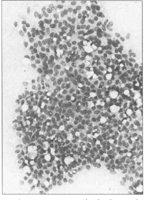 Figure 1 From Four Quadrant Fine Needle Aspiration Cytology For The Detection Of Benign