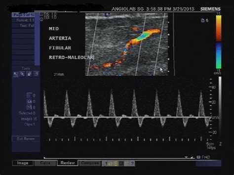 Peroneal Artery Ultrasound