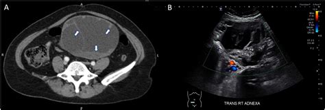 Brenner Tumor Ultrasound