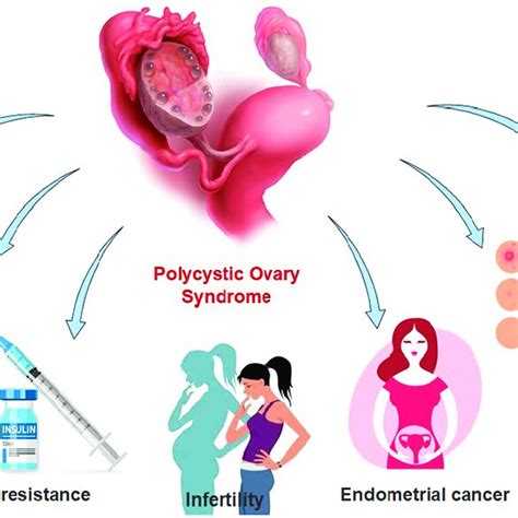 Clinical Manifestations Of Polycystic Ovary Syndrome Pcos