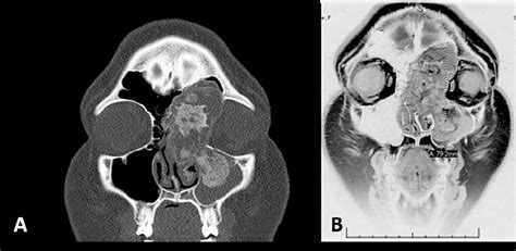 Clinical Pathologic Conference Case An Expansile Sinonasal Mass With