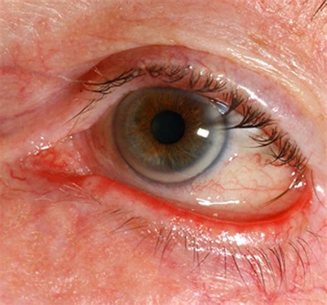 Ectropion Eye Diseases Epharmapedia