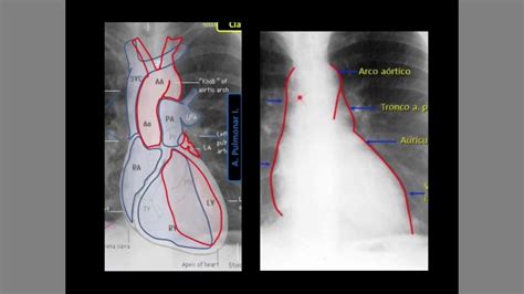 Radiografía De Tórax Youtube