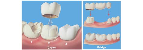 Dental Crowns And Bridges