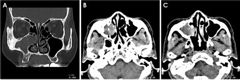 Characteristic Features Of Fungus Ball In The Maxillary Sinus And The