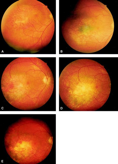 Photodynamic Therapy For Symptomatic Choroidal Hemangioma Ophthalmology