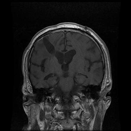 Solitary Fibrous Tumor Hemangiopericytoma Image Radiopaedia Org