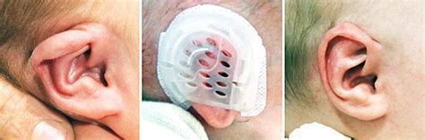 Ear device corrects newborn ear deformities without surgery | News ...