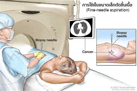 มะเร็งปอด Lung Cancer อาการ สาเหตุ การรักษาโรคมะเร็งปอด 12 วิธี