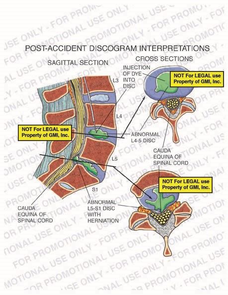 Post Accident Discogram Interpretations 97213b23a Generic Medical Legal Exhibits A Division