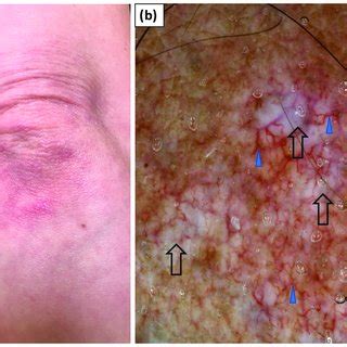 (a) Clinical presentation of Gottron's sign over the elbow. (b)... | Download Scientific Diagram
