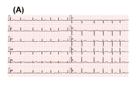 Twelve Lead Electrocardiogram Ecg Demonstrating Af Rhythm On