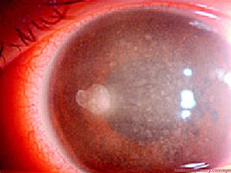 Corneal Bacterial Ulcer 1