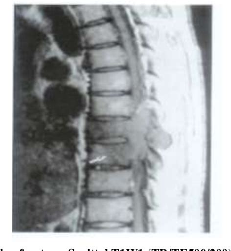 Figure 3 From Review Of Malignant And Benign Findings Of Compression Vertebral Fractures On Mri