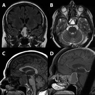 mRi performed on day 11 after the first symptoms of pituitary apoplexy ...