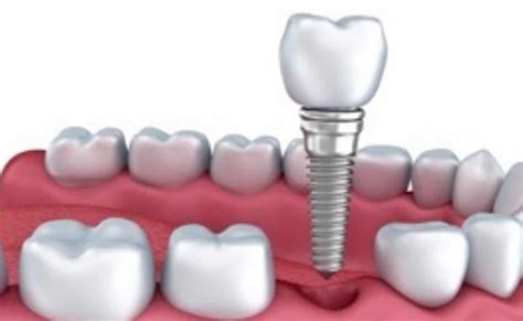 Qu Es Un Implante Inmediato Periodoncista Dr Daniel Fern Ndez